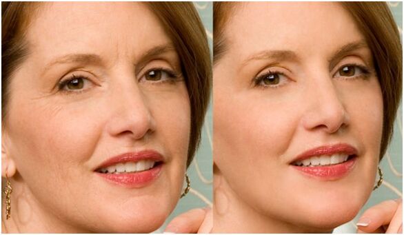 пре и после подмлађивања коже лица плазмом