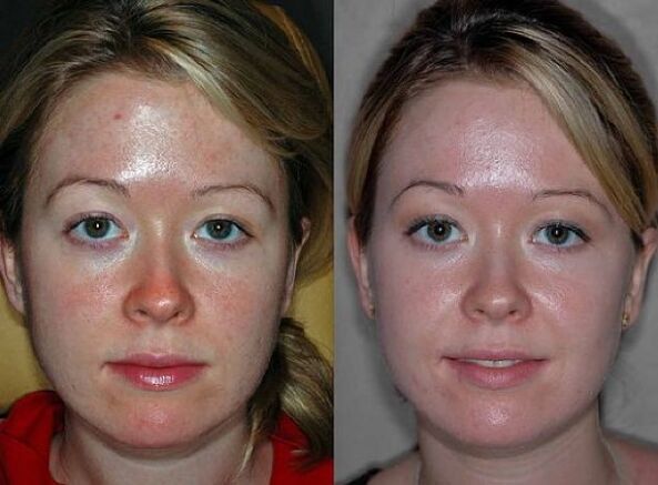 фотографије пре и после процедуре подмлађивања плазмом
