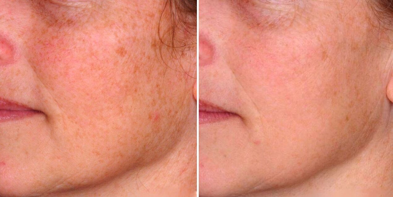 Резултат фракционе фототермолизе је смањење старачких пега на кожи лица. 