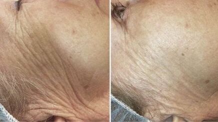 пре и после ласерског подмлађивања коже