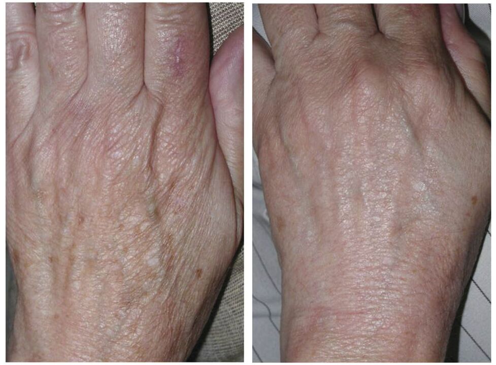 ласерско подмлађивање руку пре и после фотографија